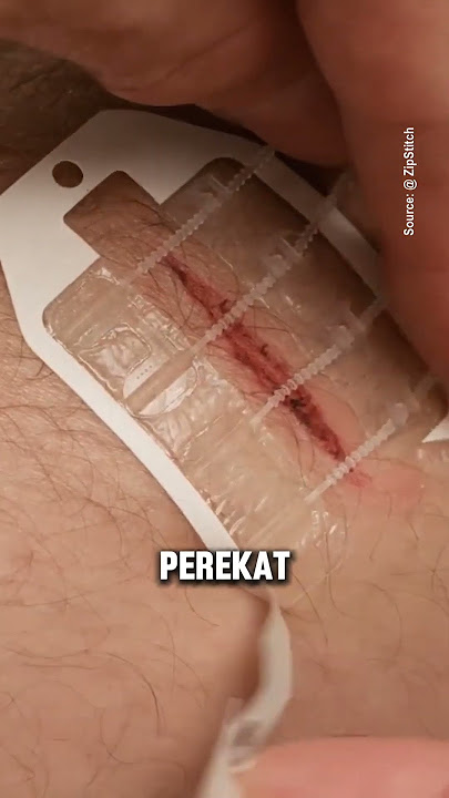 ZipStitch: Tutup Luka Tanpa Jahitan! #shorts