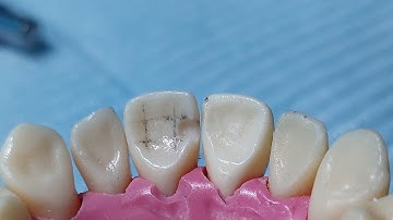 cavity preparation class III for Composite restoration/#Dr_ghazal