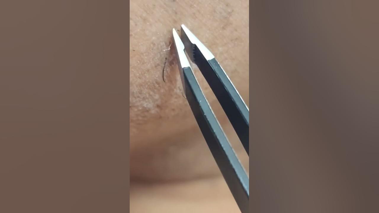 Satisfying Tweezing Extremely Stubborn Facial Hairs YouTube