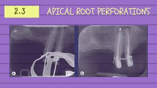 CLASSIFICATION OF PERFORATIONS IN ENDODONTICS