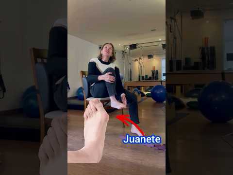 Video: ¿Los juanetes son causados por zapatos ajustados?