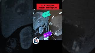 Hemangioma Treatment vasculardisease tumour cancer youtubeshorts r alcohol kidneycancer