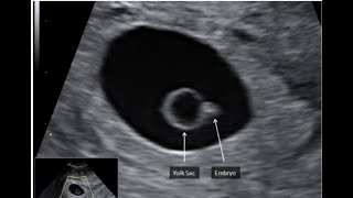 Ultrasound 6 Weeks Gestation |Early pregnancy scan |