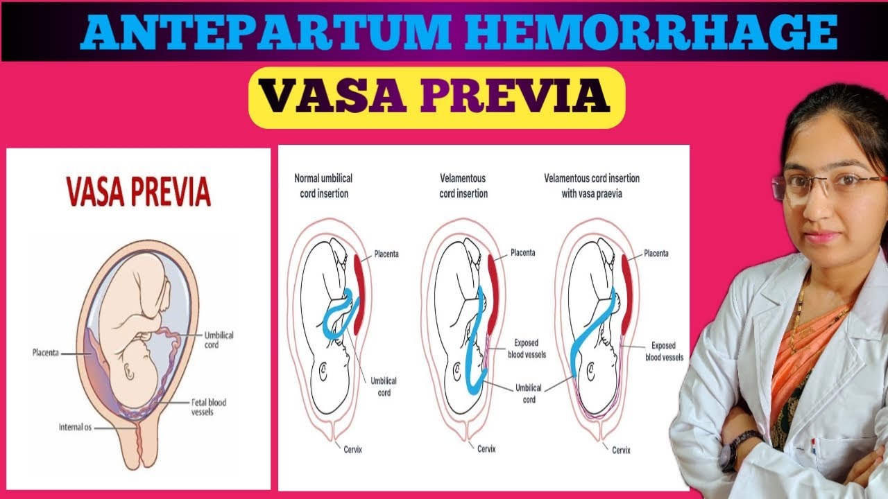 vasa-previa-antepartum-hemorrhage-causes-signs-symptoms