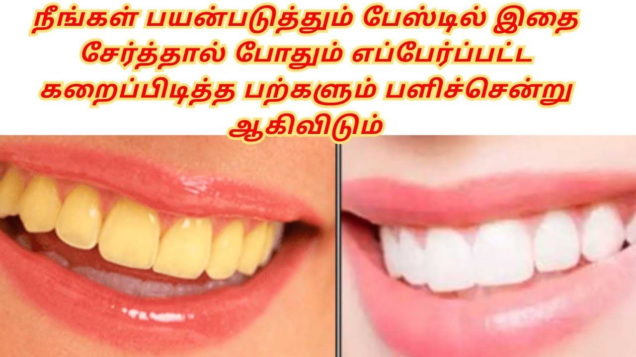 பற்களில் உள்ள மஞ்சள் கறைகளை போக்க வீட்டு வைத்தியம்/ how to teeth at