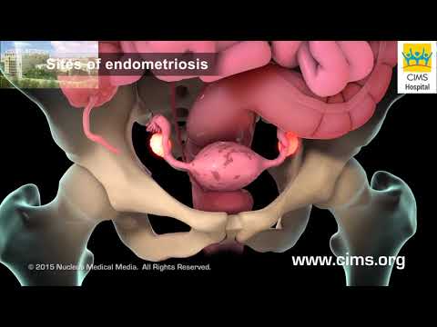 Endometriosis (Gujarati) - CIMS Hospital