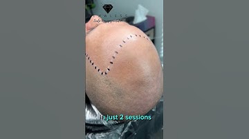 Flawless SMP Hair Tattoo Very Realistic Looking Hair by Donna #scalpmicropigmentation #hairloss