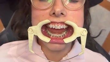 Bonding Appointments with DIBS AI Trays