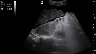 jaundice and abdominal distension