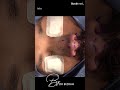 نتيحة رائعة لتجميل الأنف مع افضل وأشهر جراح تجميل انف في دبي د. بشار بزرة | قبل وبعد