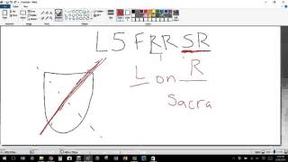 Sacral Torsion L5 diagnosis