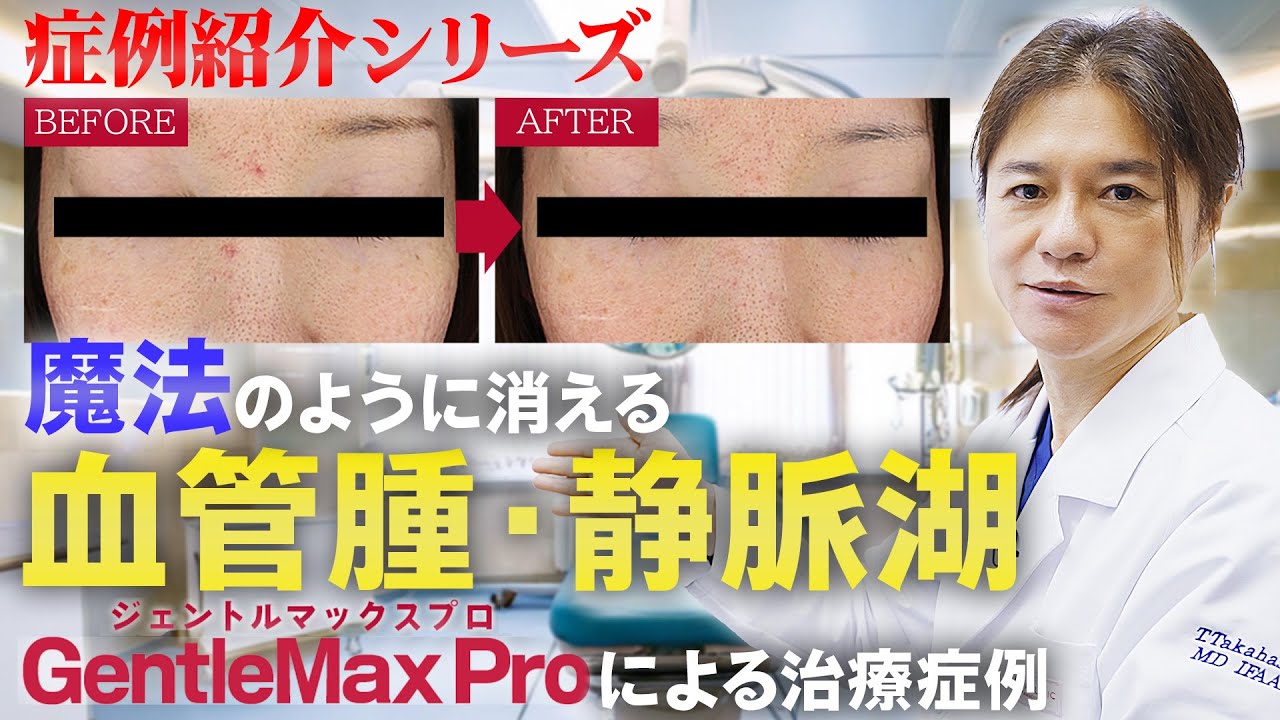 【症例紹介シリーズ】気になる血管腫や静脈湖が1発で魔法のように！！ジェントル マックス プロによる治療の症例をご紹介！！