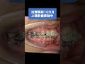 口ゴボ│高校生の歯列矯正│Eライン│ワイヤー矯正│#shorts