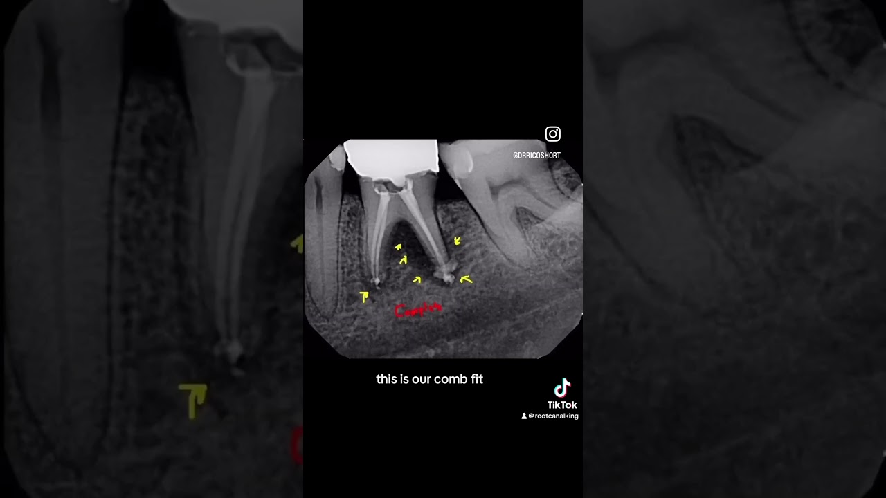 Perio Or Endo? Furcation Defect. 