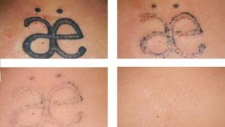 HOW TO FADE TATTOOS EASILY at Home with Natural Method