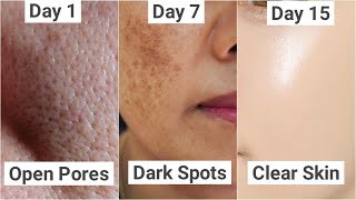 7 ದಿನದಲ್ಲಿ Large Pores, Dark Spots ಹೋಗಿ Crystal Clear Smooth ಸ್ಕಿನ್ ಬೇಕಾ? | DermaCo Products Review