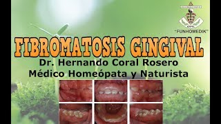 fibromatosis gingival signos y sintomas