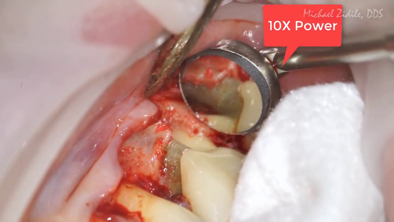 tooth number 30 youtube tooth number