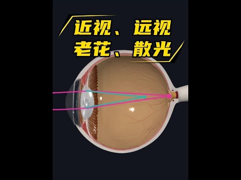 近视、远视、散光、老花眼都是怎么回事？ 近视眼的人老了眼睛会花吗？#近视 #老花眼 #远视 #散光 #健康科普有真知