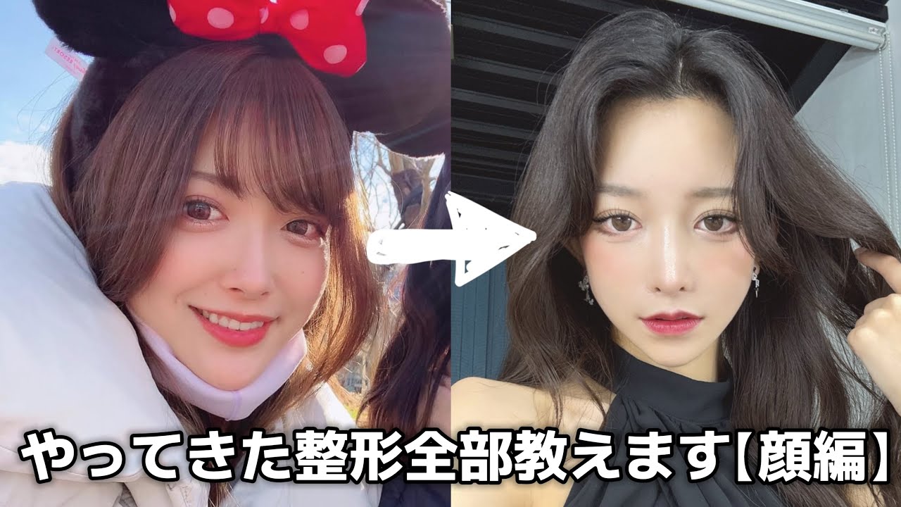 今までにしてきた整形｜顔編【ゆいぴすご飯】