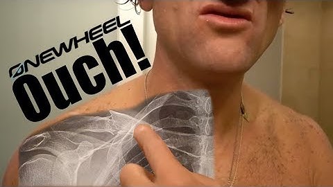 the MOST COMMON fracture on a Onewheel?