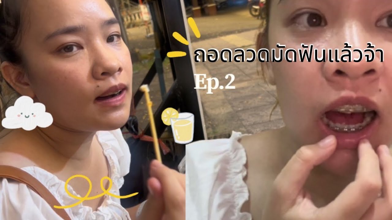 Ep.2 ถอดลวดมัดฟันแล้วจ้า 