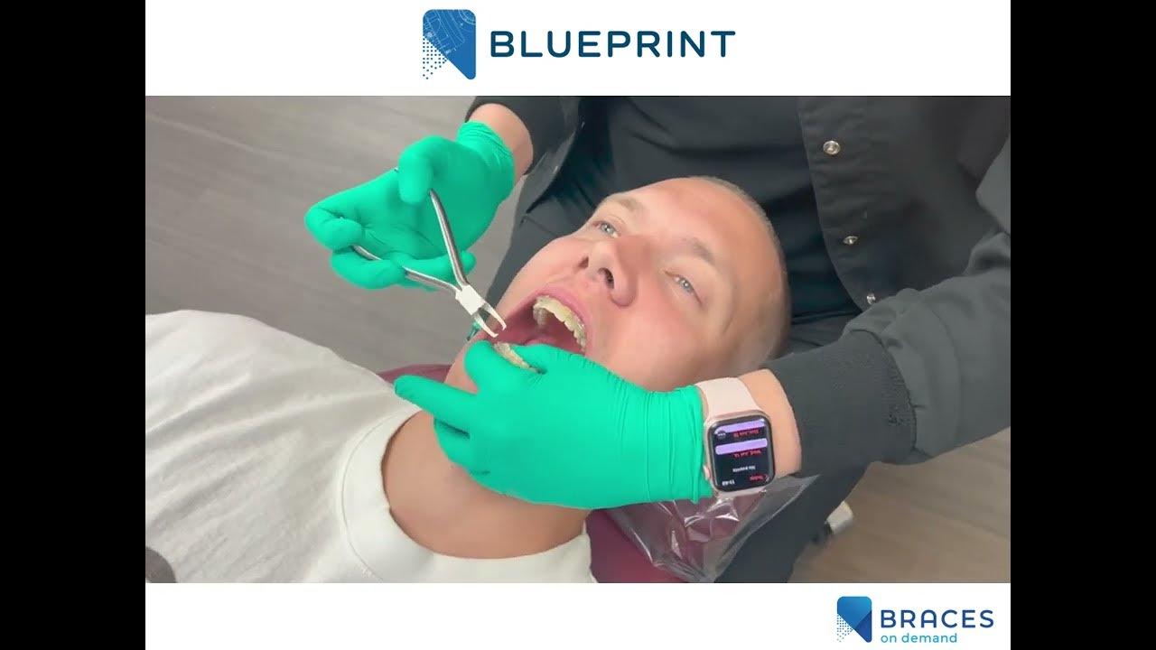 Braces On Demand How To Debond BLUEPRINT Brackets YouTube