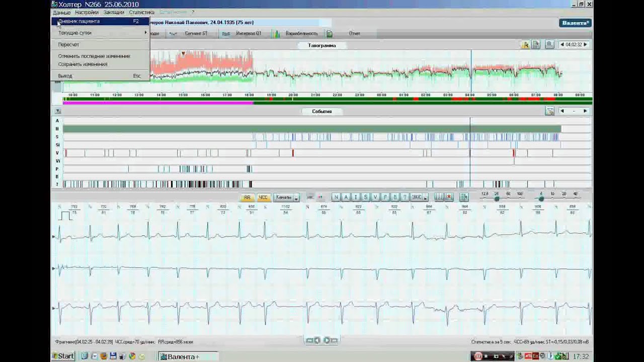 Установка холтера схема наложения 7 электродов