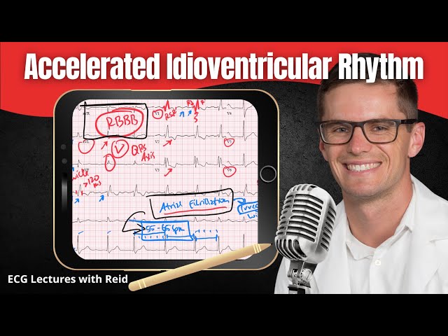 Accelerated Idioventricular Rhythms (AIVR) | ECG Lecture class=