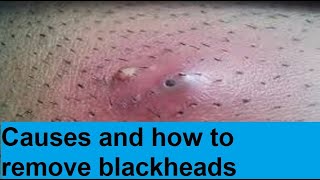 how to remove blackheads