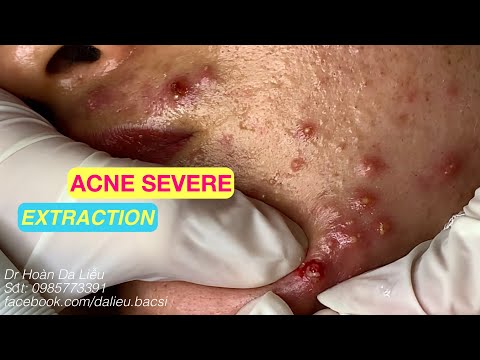 Video Nặn mụn nhọt ẩn vùng mặt siêu nhiều thâm|Squeeze big... - youtube