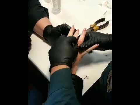Видео как снять кольцо с опухшего пальца