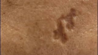 علاج اثار الجروح و الندبات/scar revision استئصال الندبات/أفضل طبيب تجميل مصر / ا.د. صابر عبد المقصود