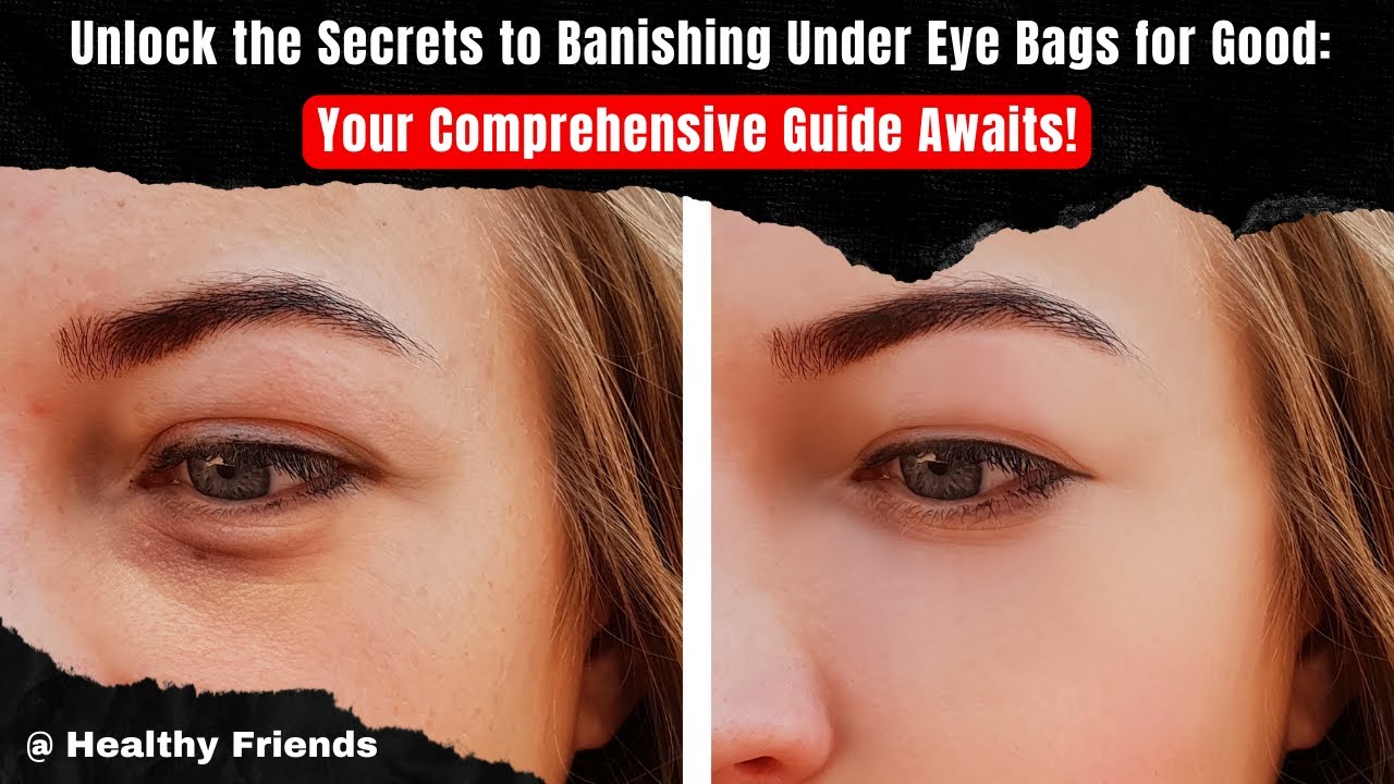 WHAT IS THE BEST WAY TO FIX EYE BAGS? HEALTHY FRIENDS BESTIE YouTube