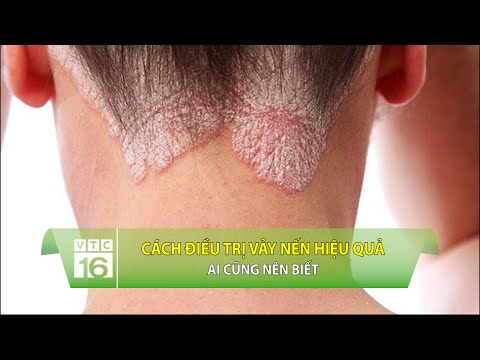 Video: Làm thế nào để nhận biết các triệu chứng bệnh lậu: 15 bước (có hình ảnh)