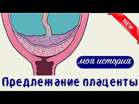 Предлежание плаценты | история моей патологии беременности
