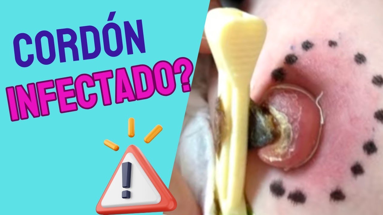 Reconoce cuáles son los Signos de INFECCIÓN de un cordón umbilical 🚨 y ...