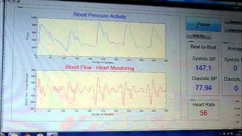 Measuring blood pressure on the carotid artery with the TLT Sapphire sensor (H)