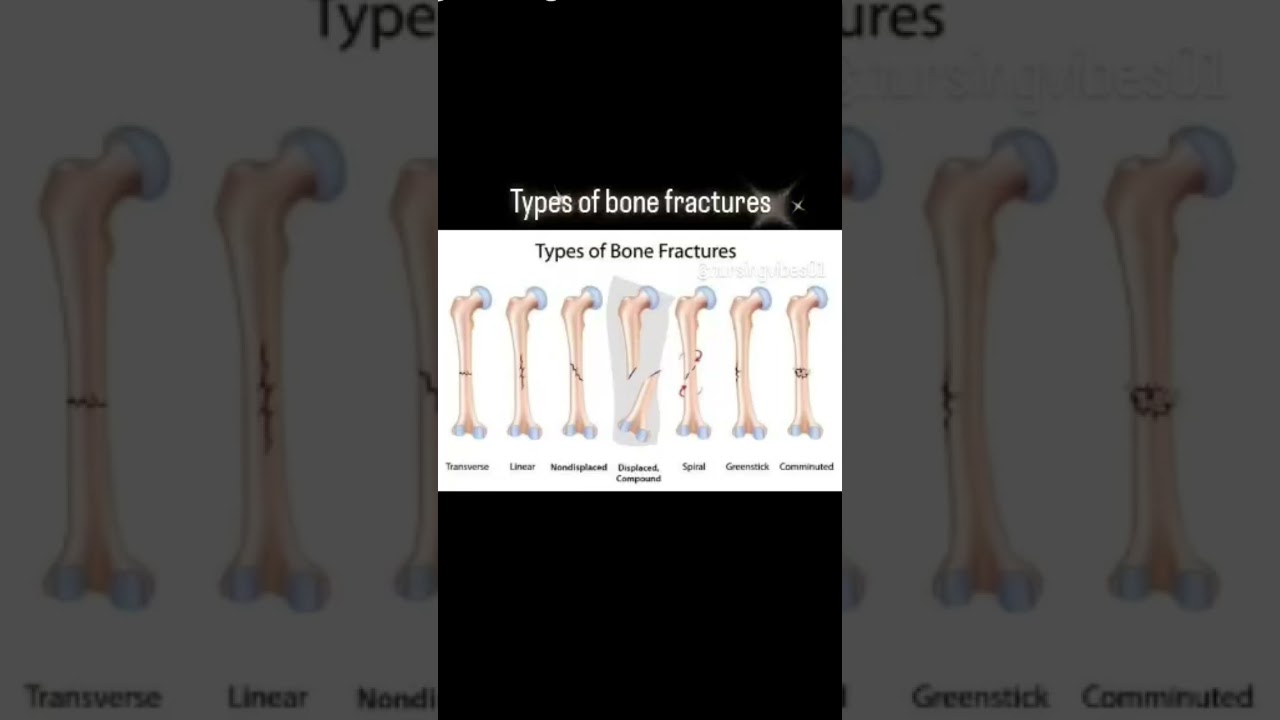 types of bone fractures.//