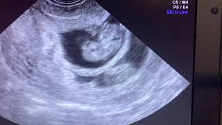 fetal reduction under ultrasound guidance