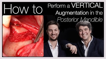 ❗️[Khoury Technique]: Vertical Bone Augmentation in the Posterior Mandible ☄️ - Advanced Techniques