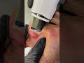 Strengthen the Ultra Sonk device to remove fat #shots