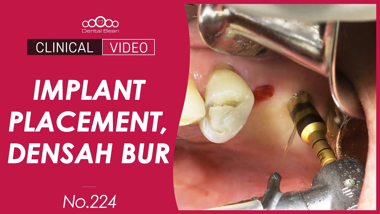 Implant placement using Densah Bur [Dr. Kim Yongjin] YouTube