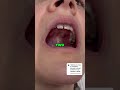 Mastering Tongue Posture  The Key to Improved Breathing and Overall Health