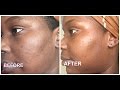 How I Got Rid Of My Dark Spots With Kiehls Spot Corrector