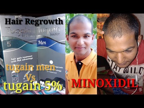 minoxidil-result-after-use-6-month।sonu-kumar-mishra।skm