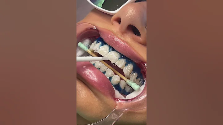 Teeth Whitening Process 🦷😱 #teethwhiteningprocedure #teethwhiteningbusiness #teethwhitening