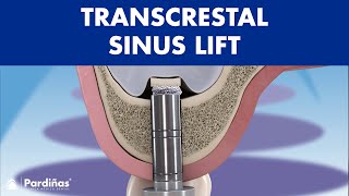 TRANSCRESTAL sinus lift  IMPLANT placement for BONELESS patients ©