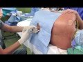 今週の硬膜外麻酔4例 4 epidural anesthesia by Dr.EpiCal