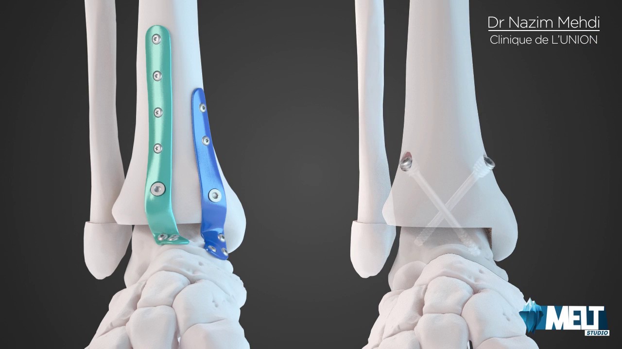 Arthroplastie Cheville avec Plaques et Vis YouTube